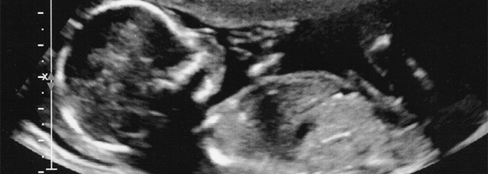 Is there a connection between autism and ultrasound?