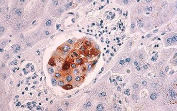 Image of breast cancer cells metastasized to the liver 