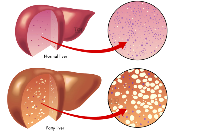 fatty livers are larger and have more fat deposites than normal livers.