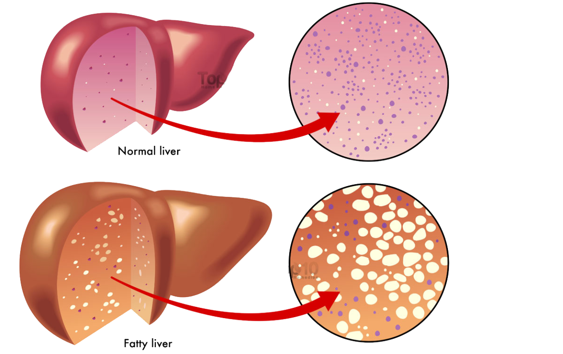 Non alcoholic fatty liver